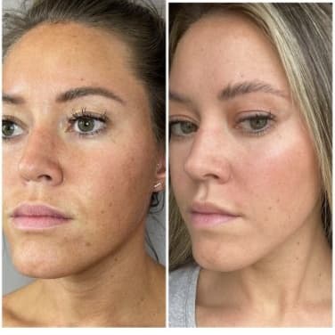 3 Opus Treatments at The Laser Collective in Gilbert, AZ